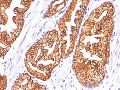 FFPE human prostate carcinoma sections stained with 100 ul anti-Ornithine Decarboxylase-1 (clone SPM565) at 1:300. HIER epitope retrieval prior to staining was performed in 10mM Citrate, pH 6.0.